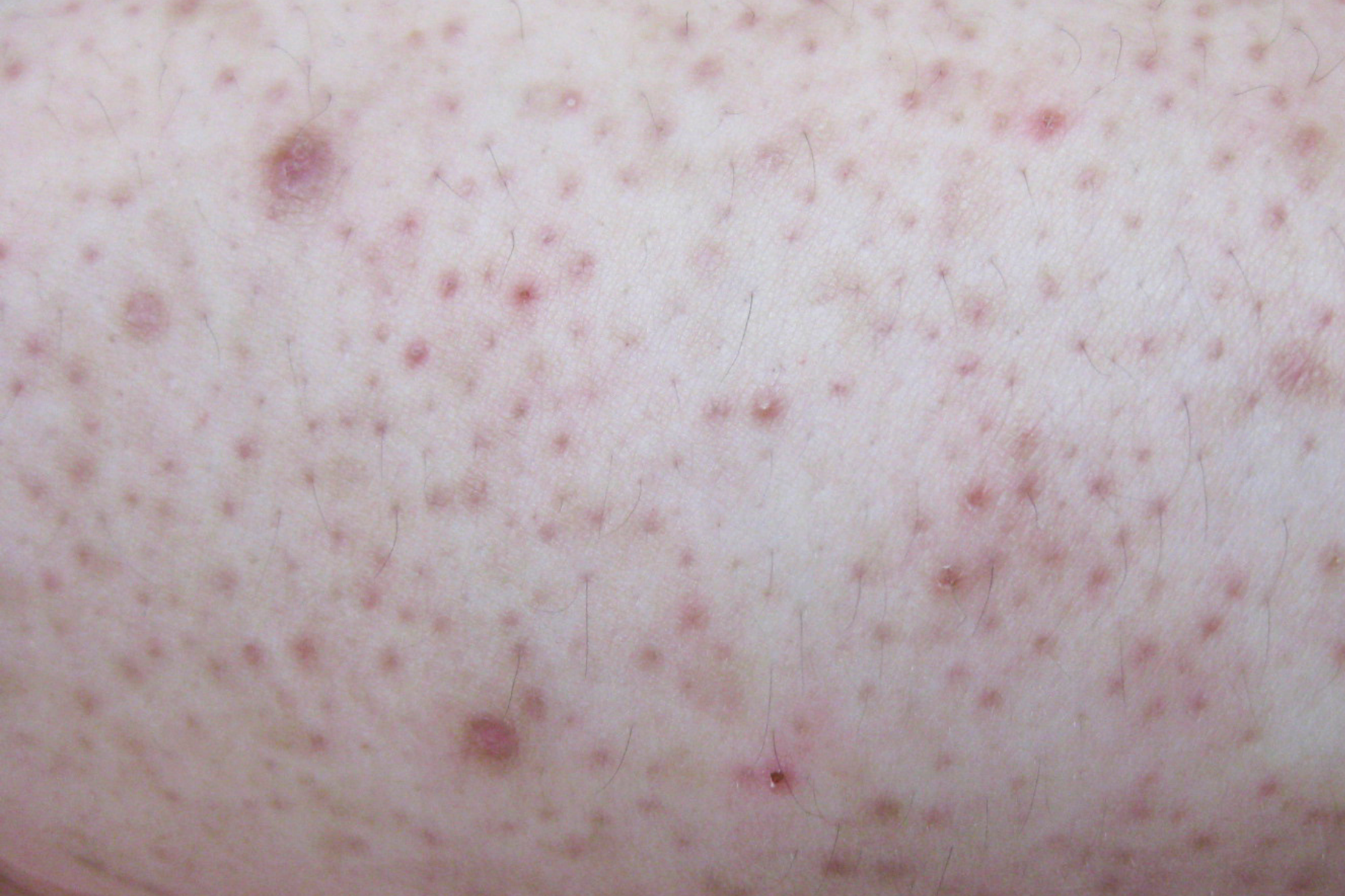 HAUT WIE EIN REIBEISEN