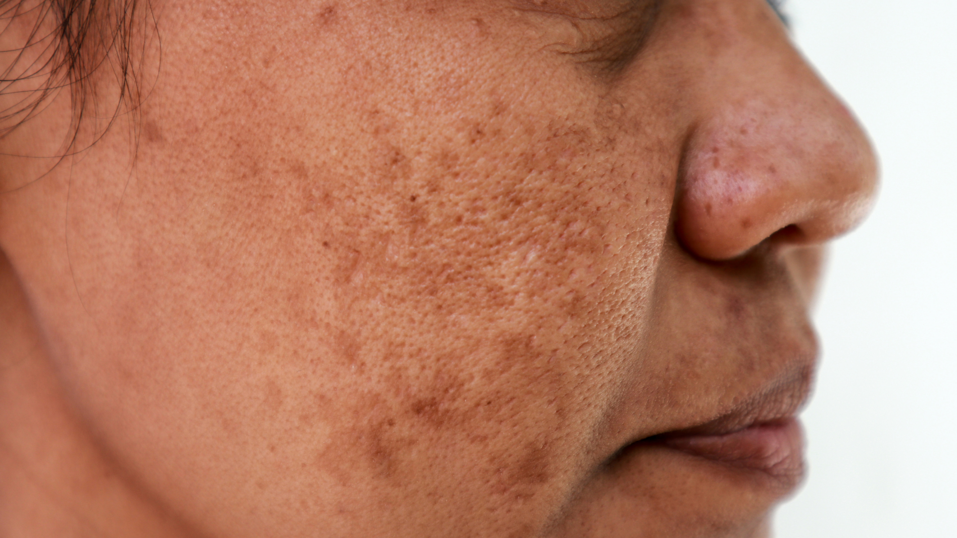 Melasma richtig behandeln - Endlich Abhilfe bei dunklen Pigmentflecken